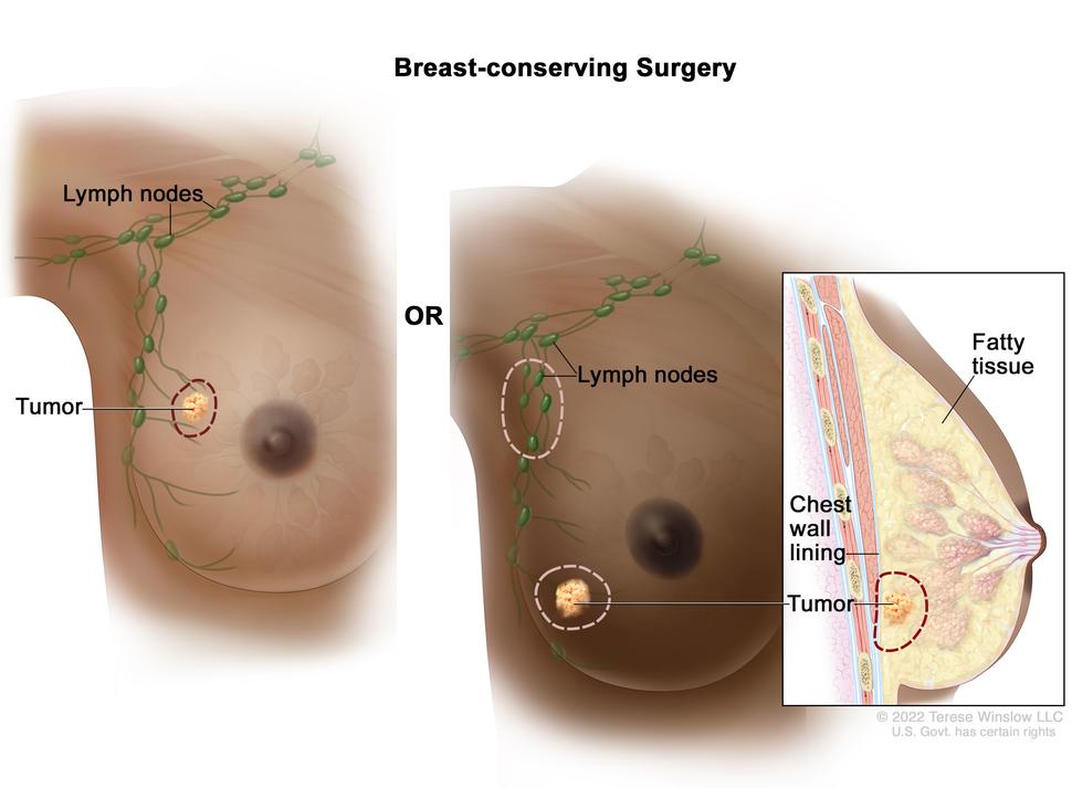 mammary-cancer