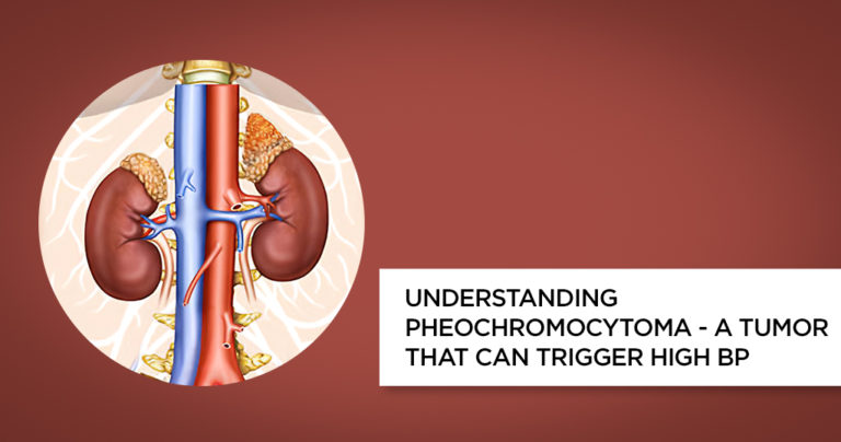 understanding-the-pheochromocytoma,-a-cancer-that-may-cause-high-blood-pressure